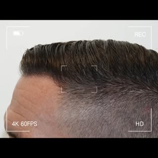Eine natürliche Haarlinie steht allen Patienten/innen gut. 😊
#hairtransplantbeforeafter #fuehairtra