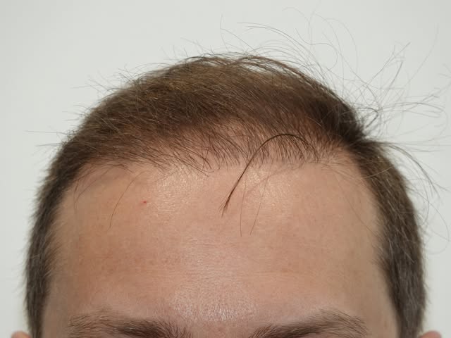 Nicht jede Haartransplantation führt auf Anhieb zum erhofften Resultat. Dieser Patient kam zu uns, n