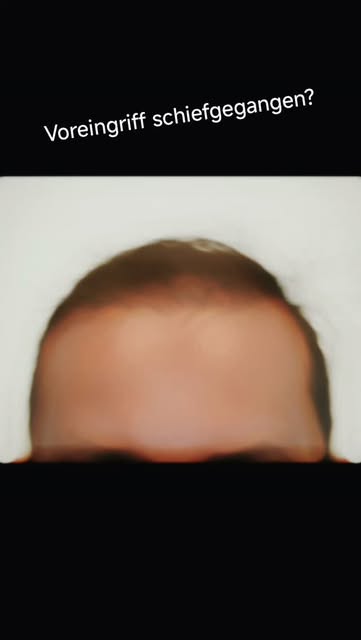 ​Nicht jede Haartransplantation führt auf Anhieb zum erhofften Resultat. Dieser Patient kam zu uns, 
