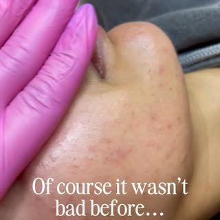 People think they need treatment only when acne gets severe…
But healthy skin starts before that sta