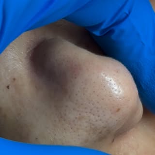 🍓 Turning strawberry skin into smooth skin. Those tiny dots had to go. 😌
.
.
.
.
#skin #blackhead 