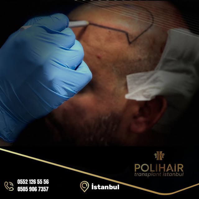 In hair transplantation, the front hairline is crucial for a natural look. A well-designed, symmetri