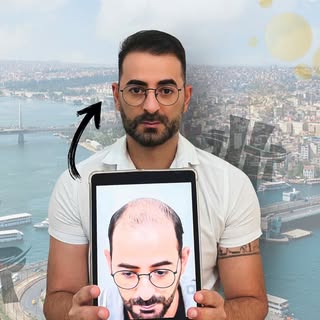 Our advanced techniques ensure a seamless, natural-looking hairline that blends perfectly with your 