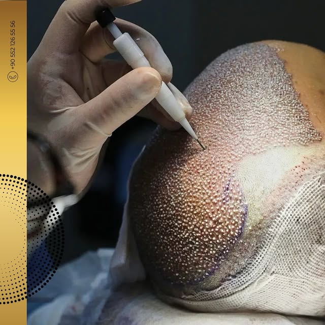 Transform Your Look with DHI Hair Transplant! 🌟

At PoliHair, we specialize in the innovative DHI (