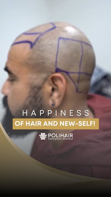 Struggling with hair loss can take a toll on your confidence, but a hair transplant offers a long-te