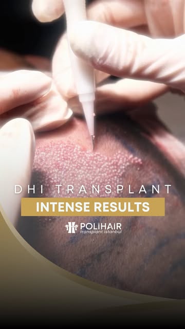 Tired of thinning hair or receding hairlines? A hair transplant can be a life-changing solution that