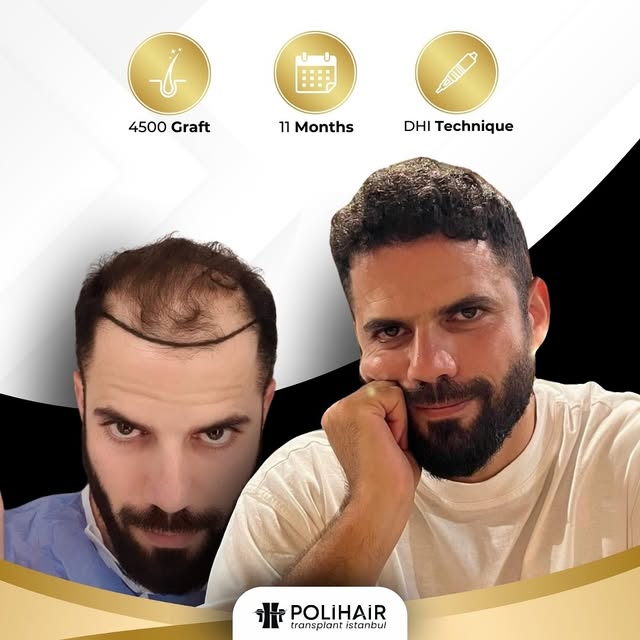 Experience the transformation! 🌟 Hair transplant results aren’t just about regaining hair; they’re 