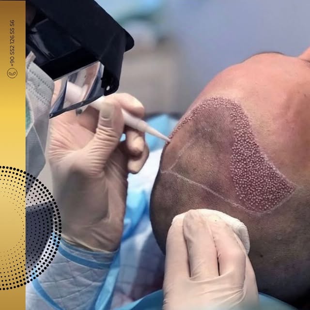 The Key to Successful Hair Transplants? A Great Team! 🌟

Behind every life-changing hair transforma