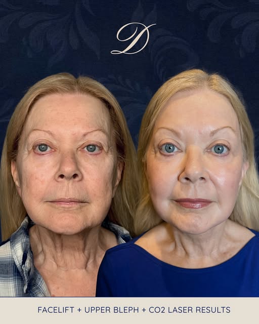 This patient came in ready for a refreshed, more youthful appearance, and her treatment plan was des