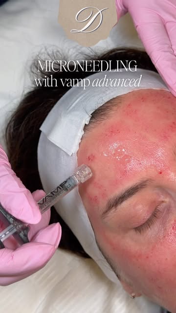 Your skin already knows how to repair itself… sometimes it just needs the right signal 

Microneedli