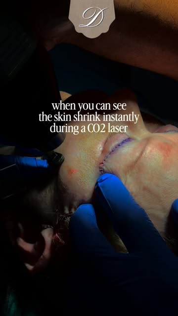 Watch the tightening happen in real time. 👀

CO₂ laser resurfacing performed post-facelift helps ad