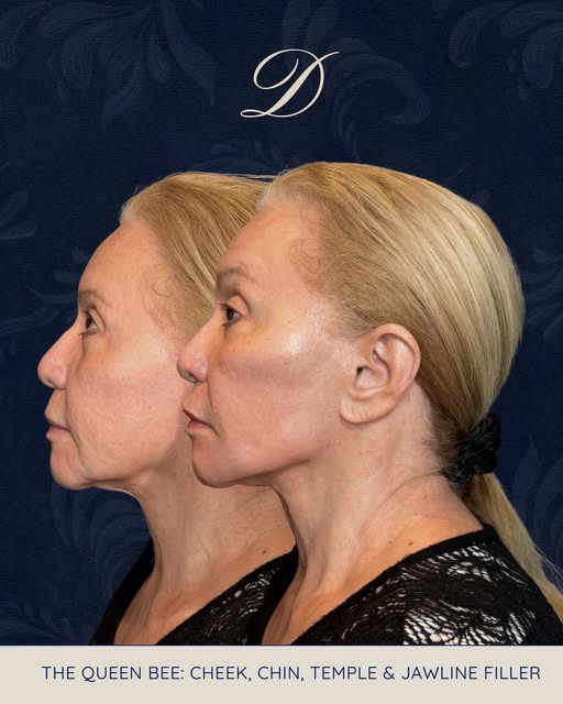 👑 THE QUEEN BEE 🐝

The ultimate Full Facial Balancing treatment combining filler + biostimulators 