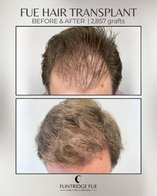 2,857 grafts. One incredible transformation. 👏 This FUE hair transplant restored density to the cro