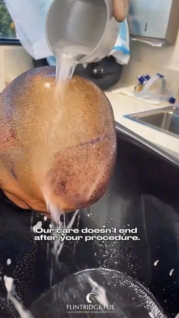 First Hair Wash After FUE ✨ Two days after FUE, our patient returned for their first post-procedure 