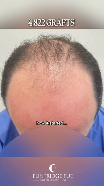 What a difference 4,822 grafts can make.☑️
How it started vs. how it’s going. 

#fueresults #results