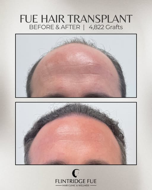 4822 grafts for the win! A major transformation focused on restoring the crown and receding hairline