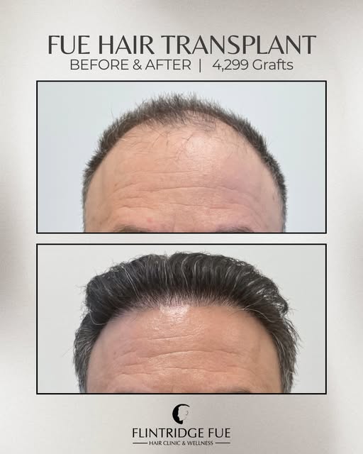 4,299 grafts for the win! 🙌🏼 This transformation focused on restoring areas of thinning and hair l