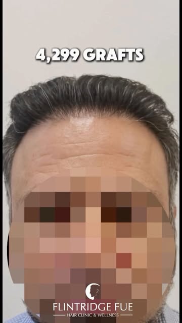 4,299 grafts, one major transformation. 🙌🏼 By strategically restoring areas of thinning and hair l