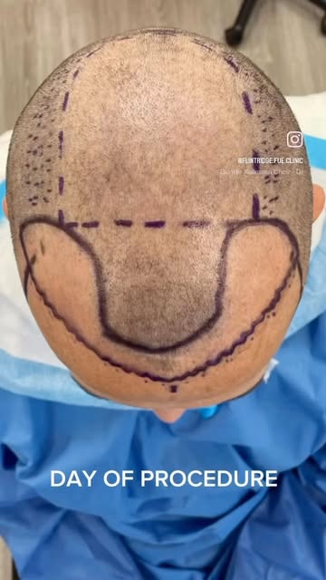 TRUST the FUE process…Hair restoration takes time, patience, and consistency — but the progress alon