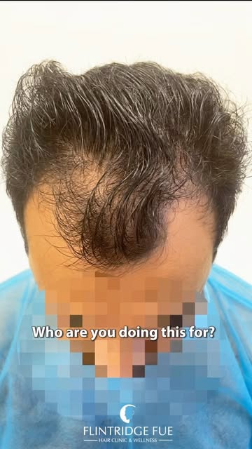 Who are you doing this for? A more confident you. 🙌

Hair restoration isn’t about becoming someone 