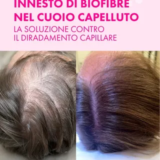 DIRADAMENTO CAPILLARE? NON È SOLO ESTETICA ⬇️

Il diradamento spesso tocca profondamente l'autosti
