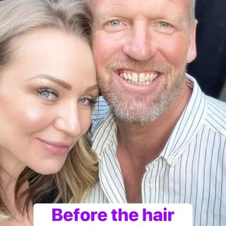 Time for an update on @benjyharlow hair transplant with @aventus_clinic #Hitchin 
6 months later and