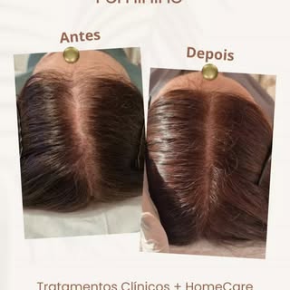Evolução de Tratamento da Alopecia de Padrão Feminino Pós-menopausa, paciente em Tratamento Domicili