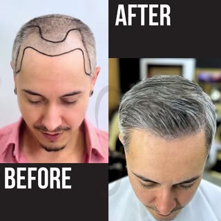 Another incredible transformation! Our client came to us with fine, light hair, and even in challeng