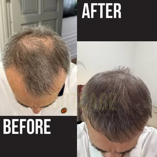 ✨61 Years Old — and Starting a New Chapter with Confidence✨

This is more than just a “before and af
