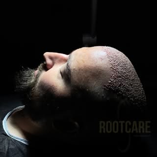 Hair transplant FUE method , immediately after the surgery: clean, clear and nice job!

Consultation