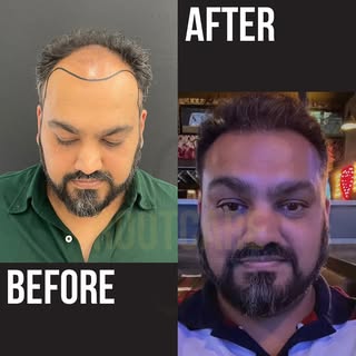 1,5 year after hair transplant! 

💫quality, quantity and results are guaranteed

📞 Reach out anyti