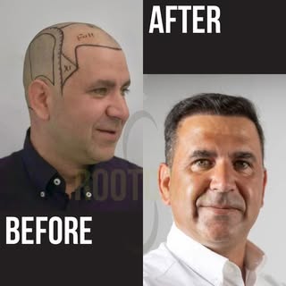 Our goal is to achieve a natural result! One year after hair transplant.

Consultation:
📱 +90 501 0