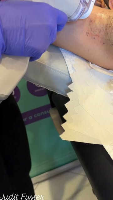 #MiraDryTreatment #SweatFree #blondish #Hyperhidrosis # SweatReduction @drmylissasmedicalboutique