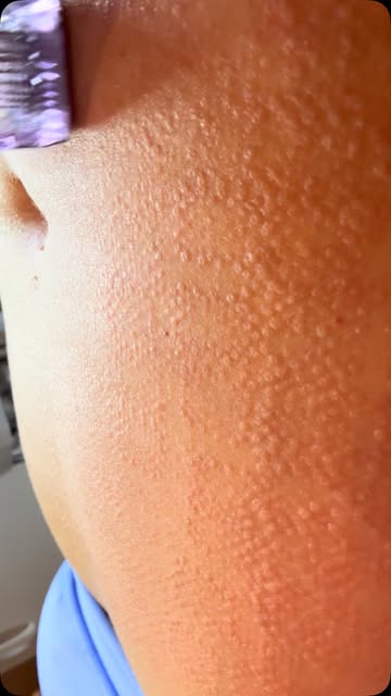 Morpheus8 is an RF microneedling treatment from InMode. It uses tiny needles to deliver fractional r