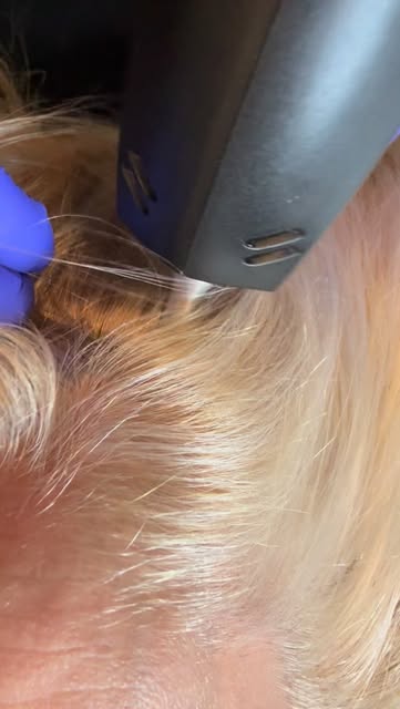 Want thicker hair but terrified of needles? * X Say goodbye to painful scalp injections and hello to