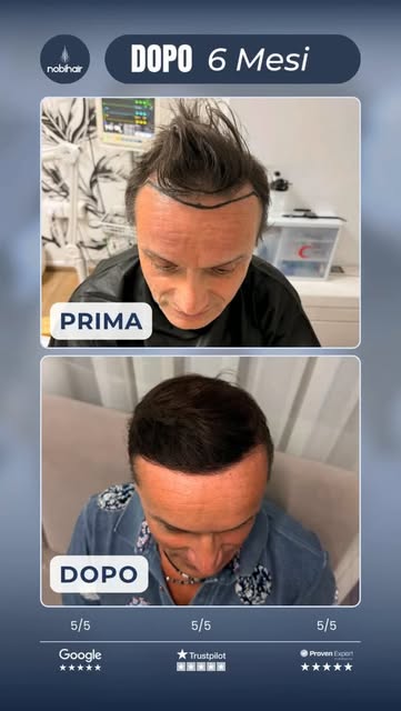 🇮🇹 Solo 6 mesi dal trapianto e il cambiamento parla da sé! 🔥
Un risultato fantastico, con maggior