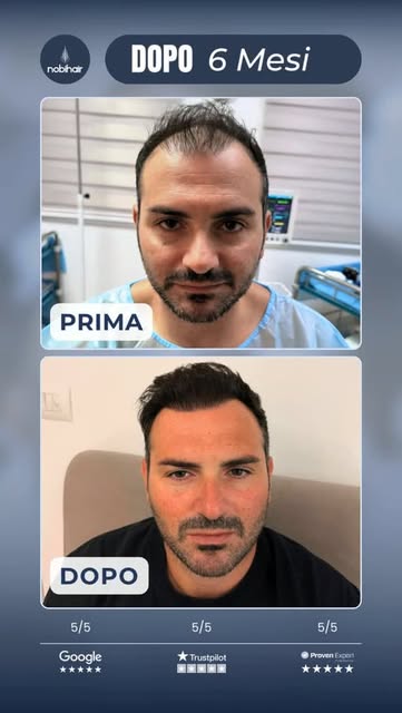 🇮🇹 Solo 6 mesi e la trasformazione è già sorprendente. ✨
Più densità, una linea frontale naturale 