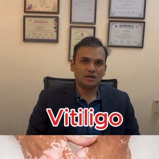 Let's learn about vitiligo. What is it and how to cure it.
#vitiligo #vitiligoawareness #vitiligotre