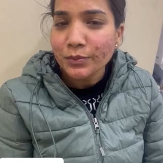 meet one of our satisfied patients suffering from dark spots.
#darkspots #skindoctor #SkinInfection 
