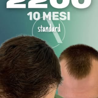 A distanza di 10 mesi dal trapianto di capelli, il risultato finale parla da sé.

Con 2200 graft è s