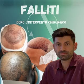 In questo video, il dottor Altan ti mostra come riconoscere i segnali di un trapianto di capelli ese