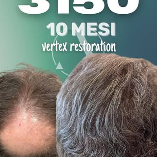 Questa volta ci siamo concentrati sulla zona del vertice (crown).
L'area da coprire era molto estesa