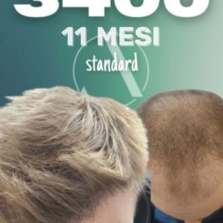 3.400 graft • 11 mesi • Risultato naturale ✨

Attaccatura naturale ✅
Densità armoniosa ✅
Area donatr