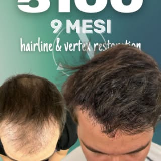 Un risultato che parla da solo. 🔥

A soli 9 mesi dal trapianto, il paziente è già felicissimo del r