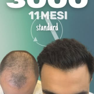Un altro risultato firmato dal Dr. Ahmed Altan - Aesteopool Clinic.✨

A 11 mesi dal trapianto, il pa