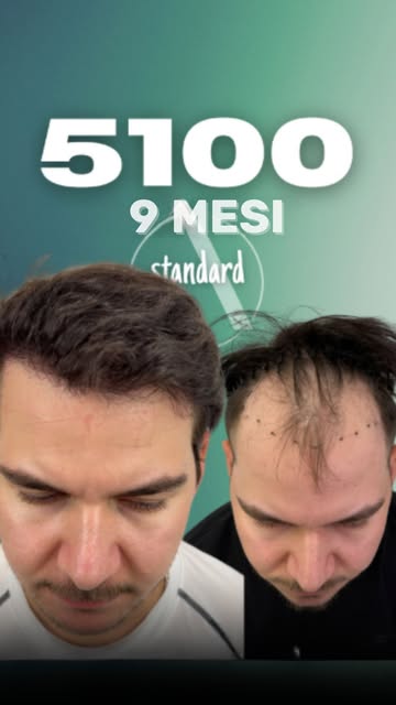 🔥 9 mesi, 5.100 grafts e un risultato già straordinario!

Siamo circa al 75% del risultato finale, 