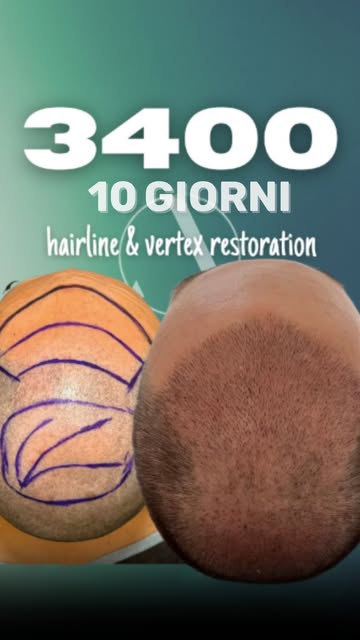 ✨ Un’attaccatura dall’aspetto naturale è il primo elemento per valutare il successo di un trapianto 
