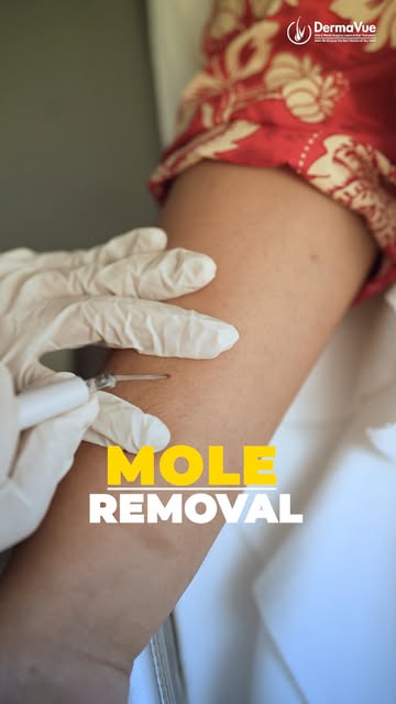 Say goodbye to unwanted moles! 
Safe, precise & dermatologist-guided Mole Removal for smoother, clea