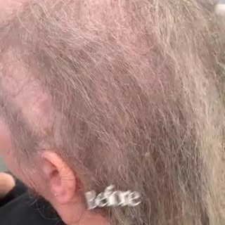 Don't suffer in silence we can give you hair#hairloss #hairrestoration #hairreplacementsystems #fema