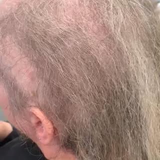 Have hair today with a volumesh system#hairloss #beforeandafter #hairrestoration #femalepatternbaldn